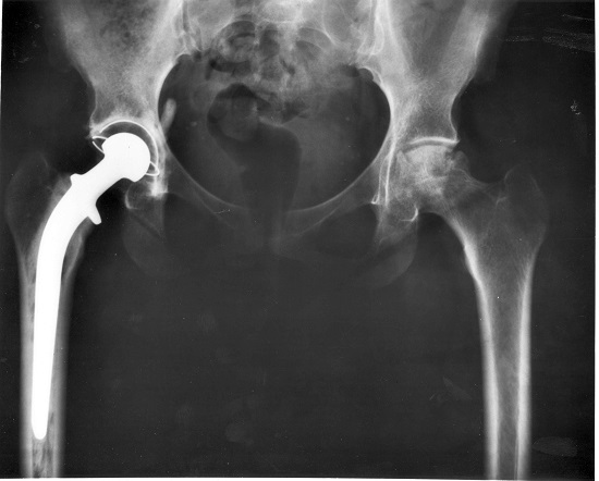 X-ray image showing a hip joint with a prosthetic implant on the left side and surrounding femur bones.